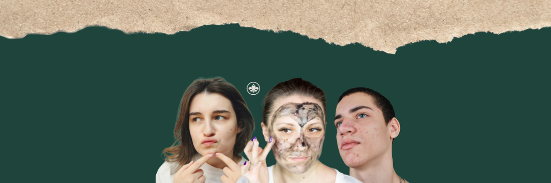 Causas del Acné, Cómo Detectarlas y Prevenirlas