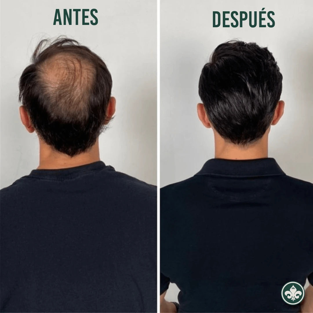 MULTIPEPTIDO ORDINARY | Detén la Caída y Recupera el volumen de tu Cabello
